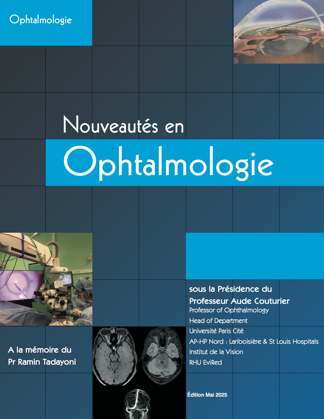 E-book | Nouveautés en Ophtalmologie 2025 E-book | Nouveautés en Ophtalmologie 2025